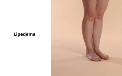 Lipedema: por que olhar apenas para a gordura não é suficiente